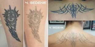 Odstránenie tetovania laserom v Inkfamous tattoo gallery