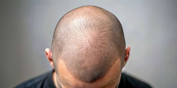 Tetovanie vlasov v štúdiu Story ink - rýchle riešenie straty vlasov, ktoré vyzerá prirodzene / Bratislava - Ružinov