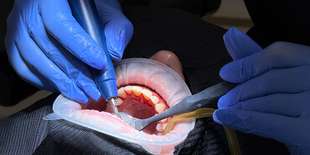 Dentálna hygiena alebo profesionálne bielenie v BL:K Dental Clinic