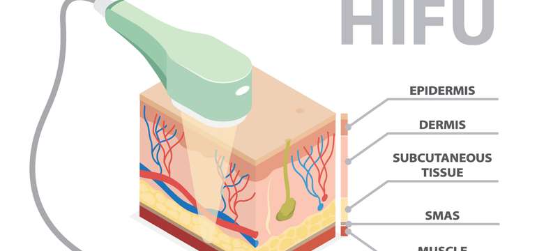 Neinvazívny facelifting HIFU (ilustračný obrázok)