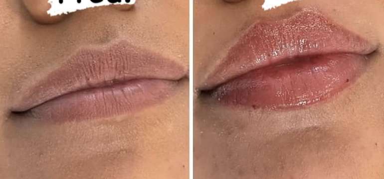 Russian Lips – profesionálna výplň pier kyselinou hyalurónovou