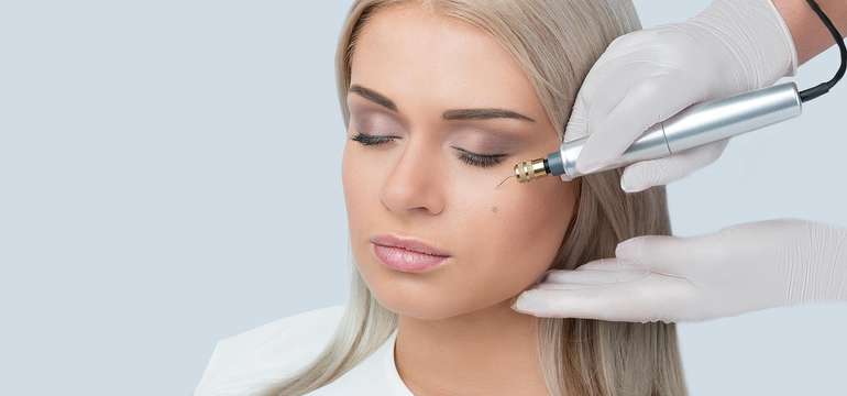 Fibroblast - nechirurgický lifting očného okolia alebo odstránenie vrások