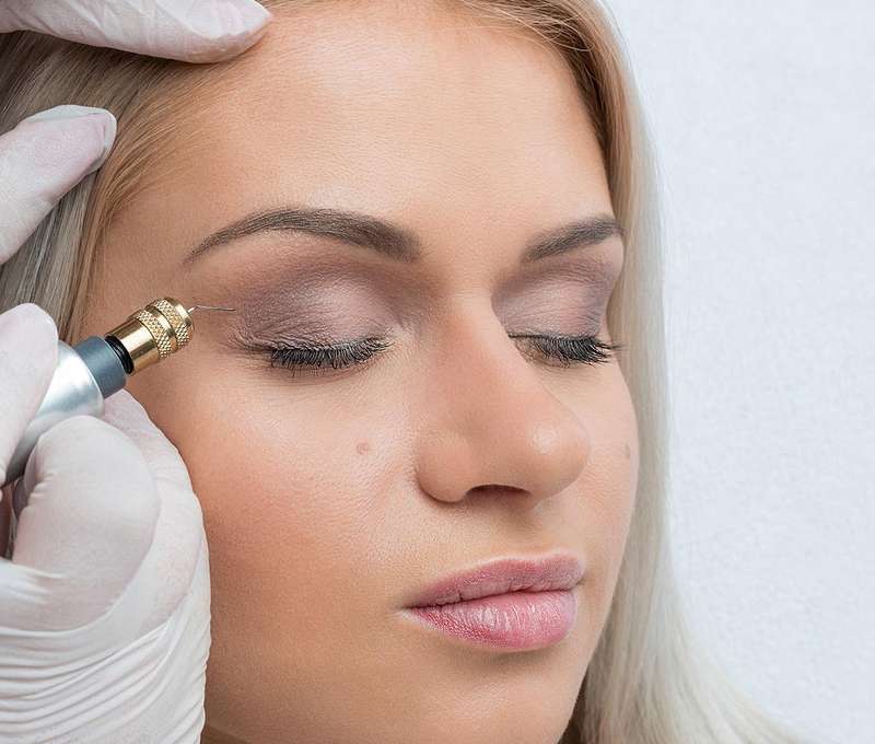 Fibroblast - nechirurgický lifting očného okolia alebo odstránenie vrások