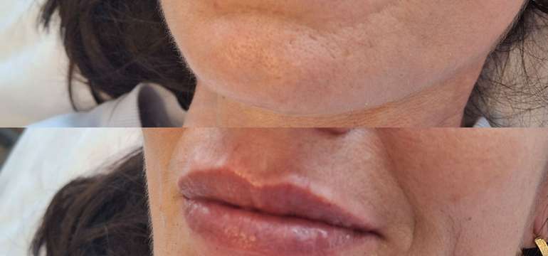 Revolučné bezbolestné zväčšenie Hyaluron Pen alebo hĺbková hydratácia Kiss Lips Therapy