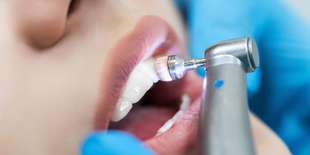 Dentálna hygiena, belenie zubov, ozónoterapia v 24 DENTAL