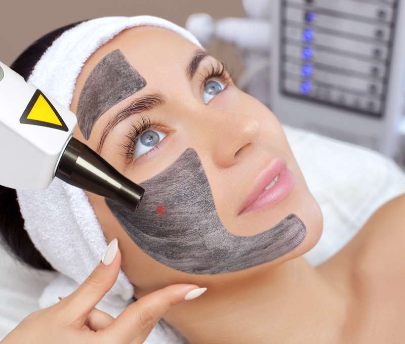 Carbon Peel (Hollywood Peel) na omladenie pleti a hĺbkové čistenie pórov (ilustračné foto)