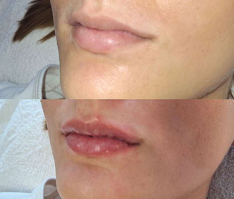 Revolučné bezbolestné zväčšenie Hyaluron Pen alebo hĺbková hydratácia Kiss Lips Therapy