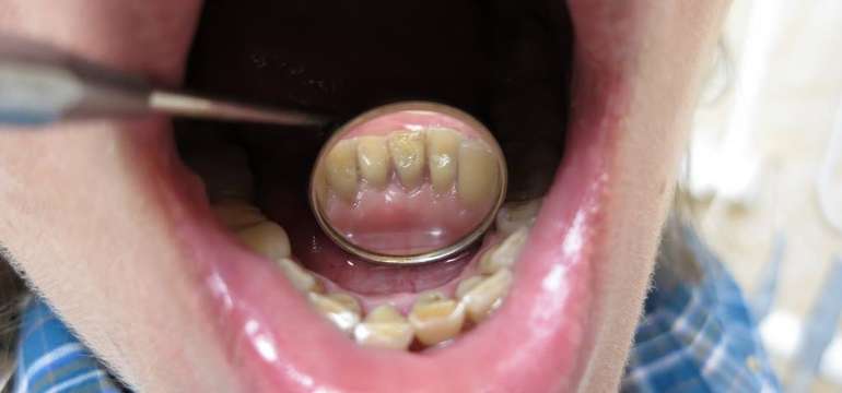 Dentálna hygiena s pieskovaním + medzizubná kefka zadarmo