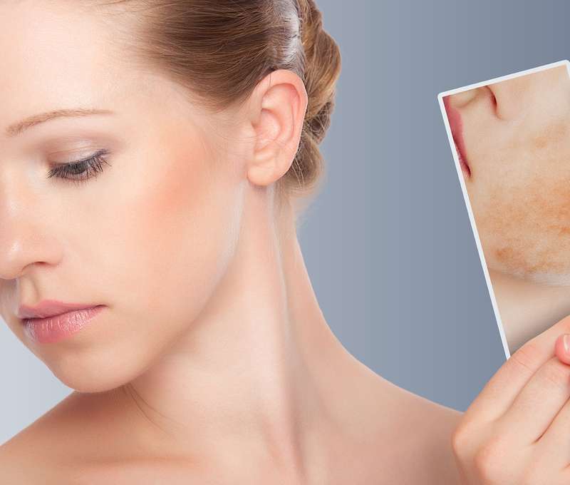 Odstránenie červených žiliek  v Beauty Esthetic Centrum