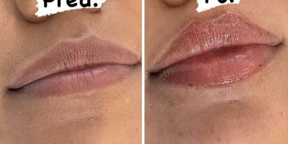 EXTRA CENA: Profesionálna výplň alebo modelácia pier technikou Russianlips/Bratislava - Staré Mesto