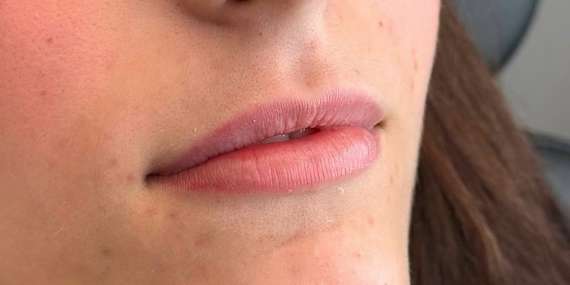 Profesionálna výplň alebo modelácia pier technikou Russianlips/Bratislava - Nové Mesto