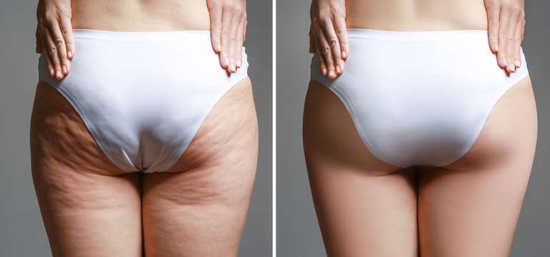 PowerShape kombinuje 3 technológie pre maximálny efekt (ilustračné foto)