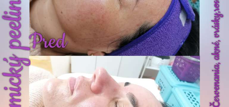Chemický peeling