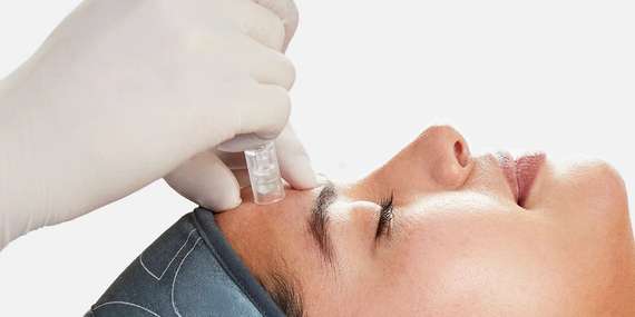 Mezoterapia pre hydratáciu, rozžiarenie a spevnenie pleti v salóne INA/Bratislava – Vrakuňa