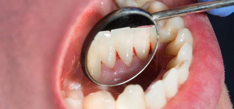 Dentálna hygiena pre váš žiarivý úsmev 