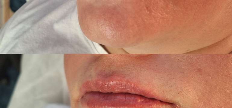 Revolučné bezbolestné zväčšenie Hyaluron Pen alebo hĺbková hydratácia Kiss Lips Therapy