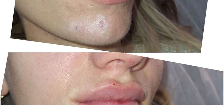 Revolučné bezbolestné zväčšenie Hyaluron Pen alebo hĺbková hydratácia Kiss Lips Therapy