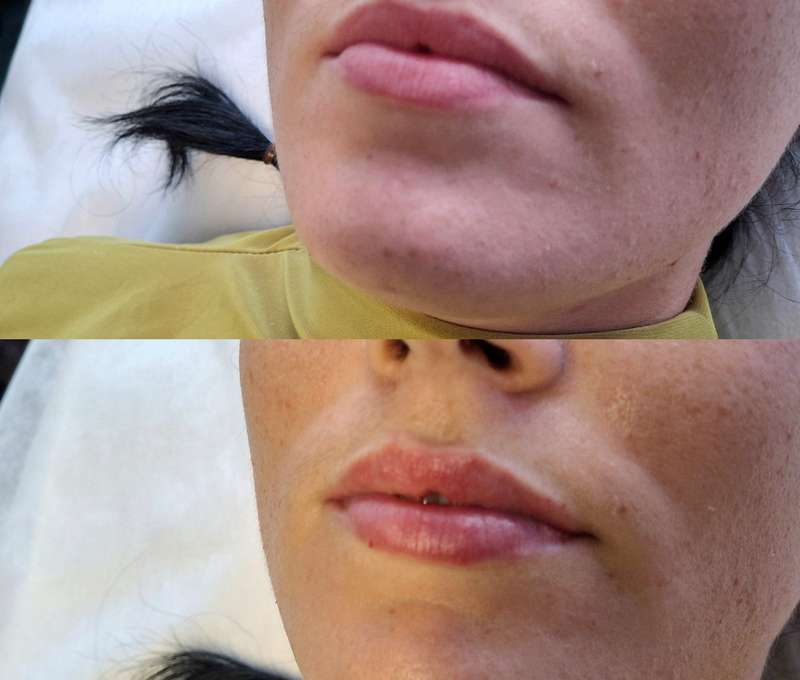 Revolučné bezbolestné zväčšenie Hyaluron Pen alebo hĺbková hydratácia Kiss Lips Therapy