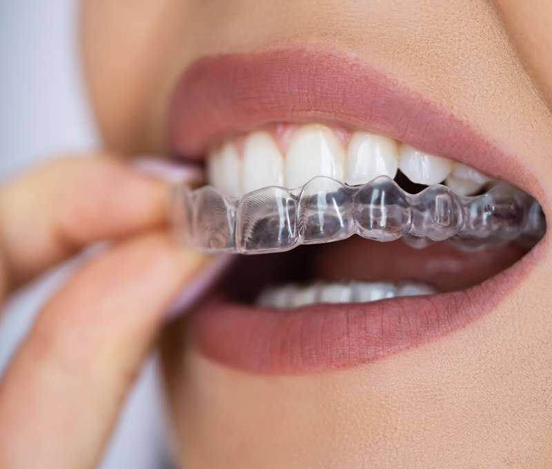 Zľava na neviditeľný zubný strojček + Dental Monitoring