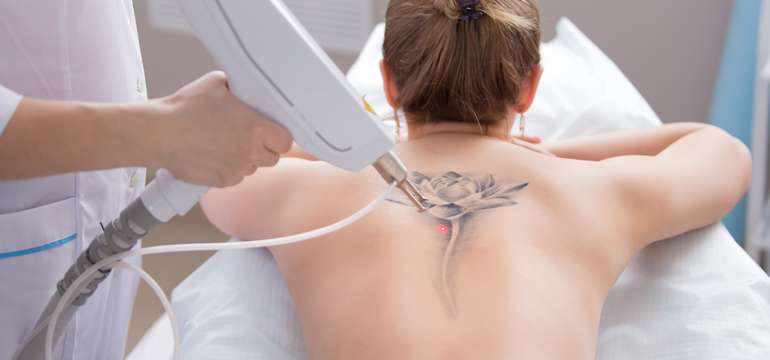 Laserové odstránenie tetovanie alebo PMU v Maya Beauty Clinic