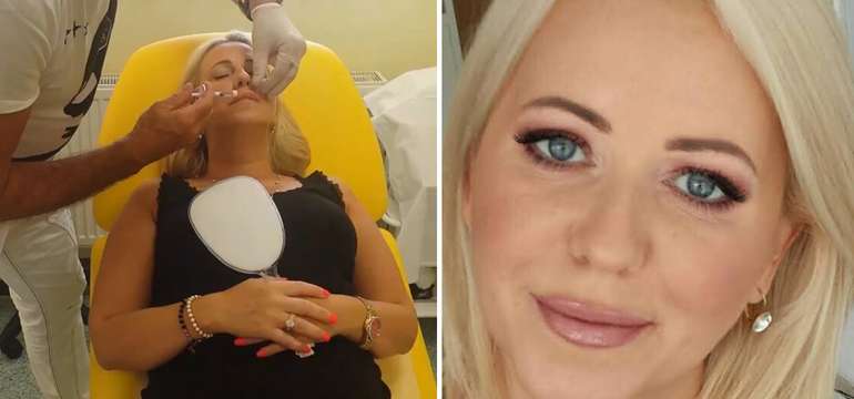 Aplikácia 1 ml kyseliny hyalurónovej Restylane Original