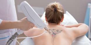 Laserové odstránenie tetovanie alebo PMU v Maya Beauty Clinic