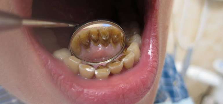 Dentálna hygiena s pieskovaním + medzizubná kefka zadarmo