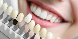 Bezpečné laserové bielenie zubov bez peroxidu v salóne Brilliant Smile