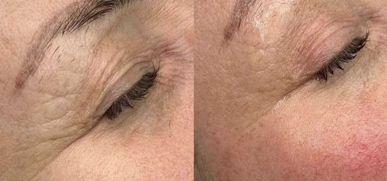 HIFU lifting, ktorý prirodzene omladí a zvýrazní vašu krásu v Amare Beauty