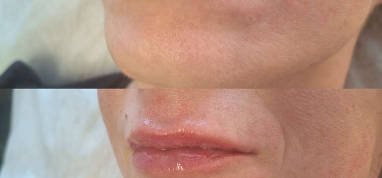 Revolučné bezbolestné zväčšenie Hyaluron Pen alebo hĺbková hydratácia Kiss Lips Therapy